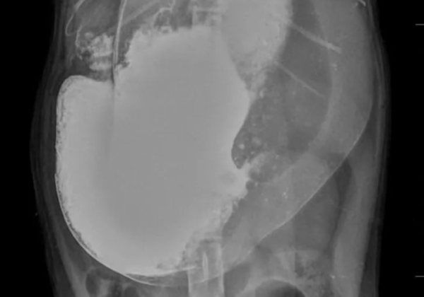 Diagnosis and discussion of foreign body in intestinal tract of a cat